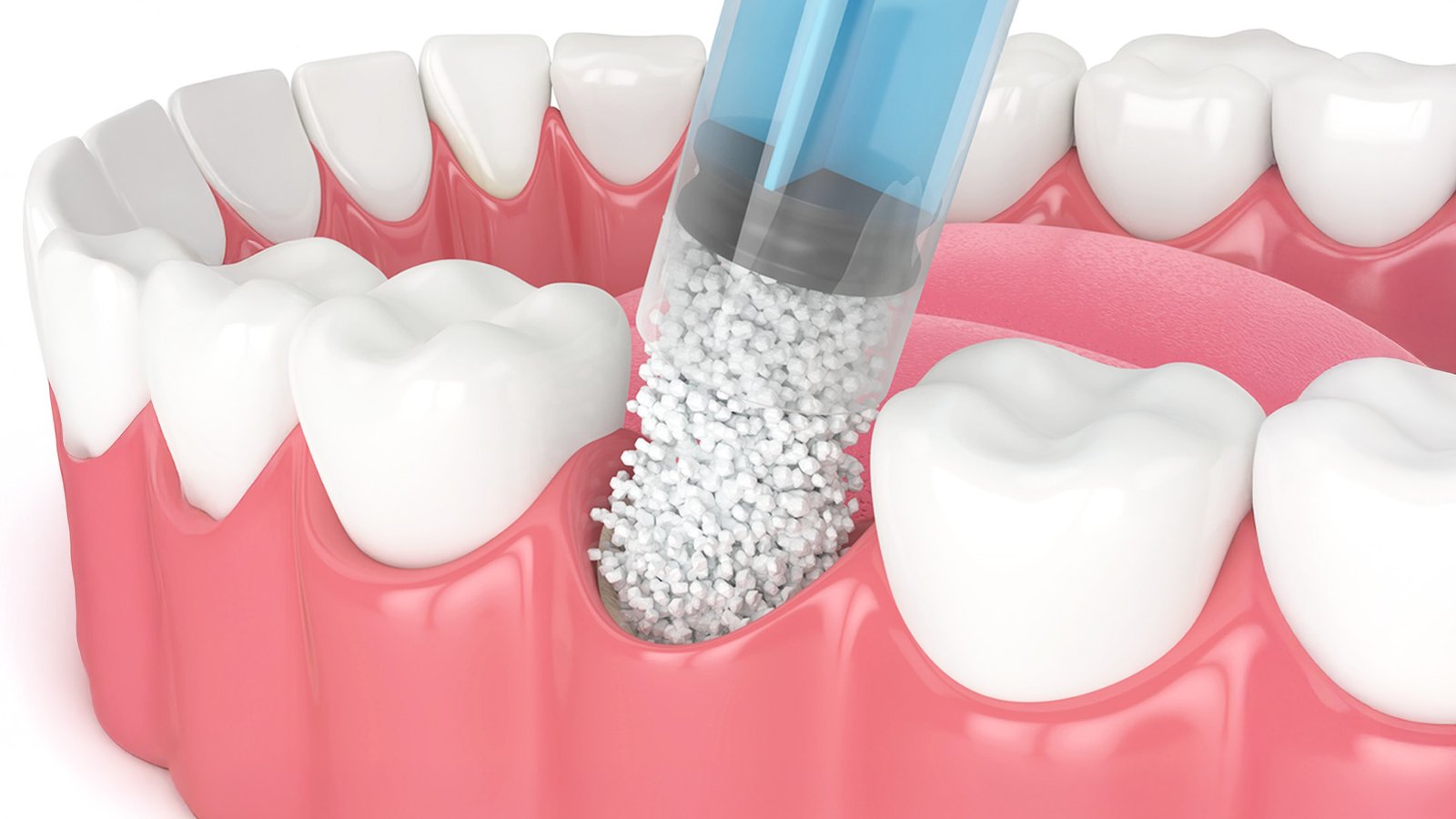 Bone Grafting Jacksonville Dental Implants