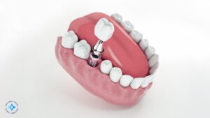All-on-4 _ All-on-X Dental Implants Jacksonville A Permanent Solution for Full Arch Restoration