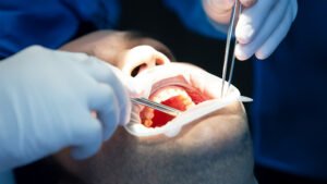 Tooth Extractions & Dental Implants Jacksonville